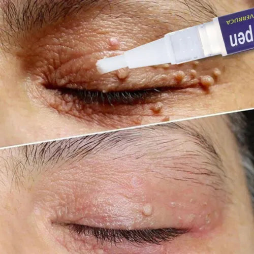 Wipe Off Tags and Mole Remover Pen